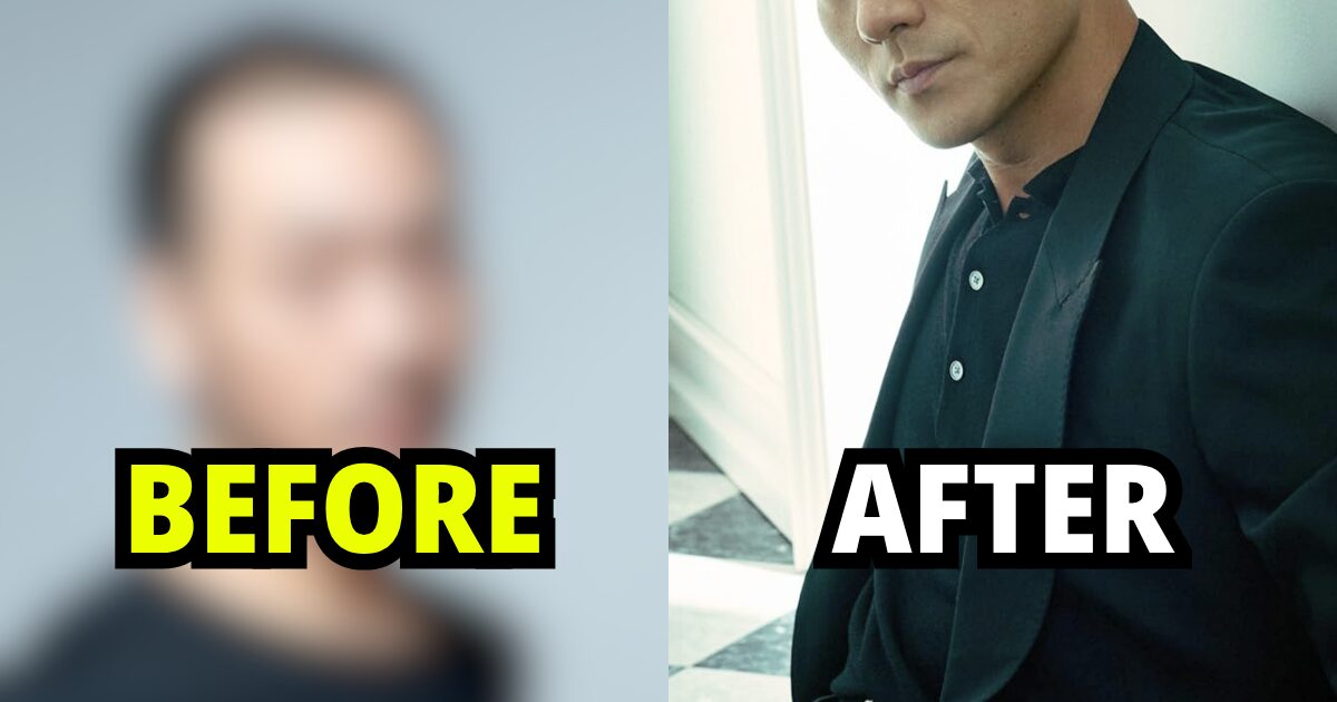 Popular Actor’s Alleged Hair Transplant Leaves Him Unrecognizable缩略图