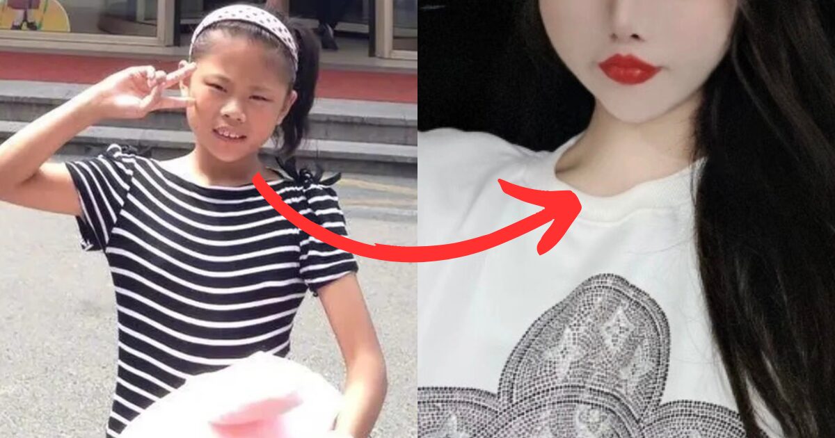 “Ruined Her Face” — The Controversial Decision To Allow A 13-Year-Old To Get Plastic Surgery缩略图