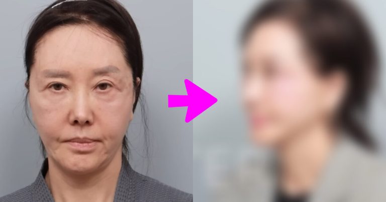 61-Year-Old Actress Shocks With New Face After Cosmetic Procedures缩略图