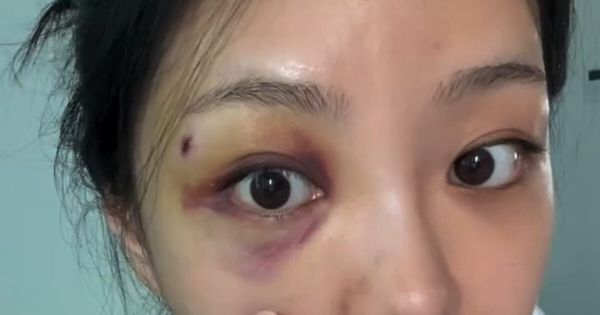 Reality Dating Show Star Addresses Rumors Surrounding Her Heavily Bruised Eye缩略图
